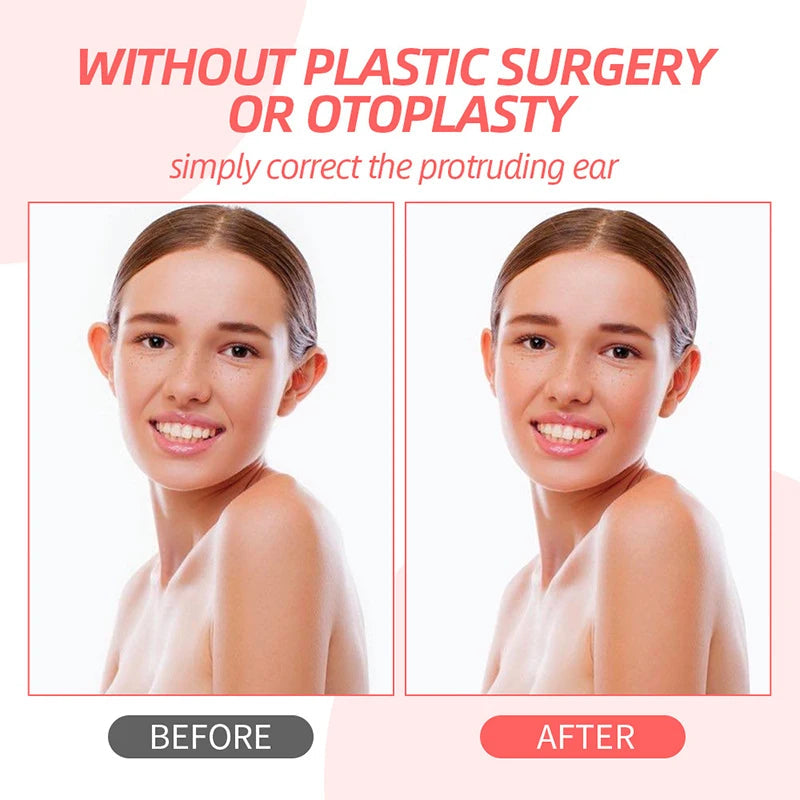 BLYNTRA Ear Fixer Patches – Invisible, Non-Surgical Correction BLYNTRA